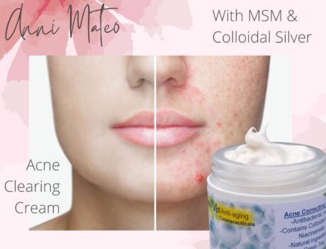 Acne Clearing Cream with MSM and colloidal silver