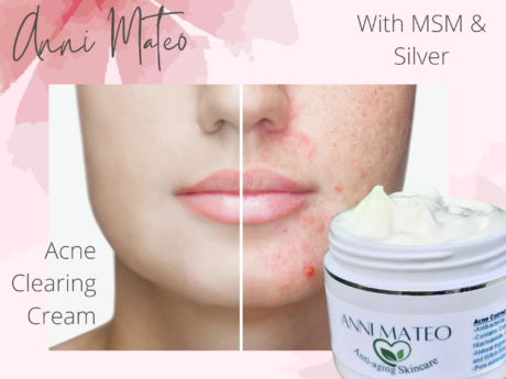 acne clearing colloidal silver and MSM cream